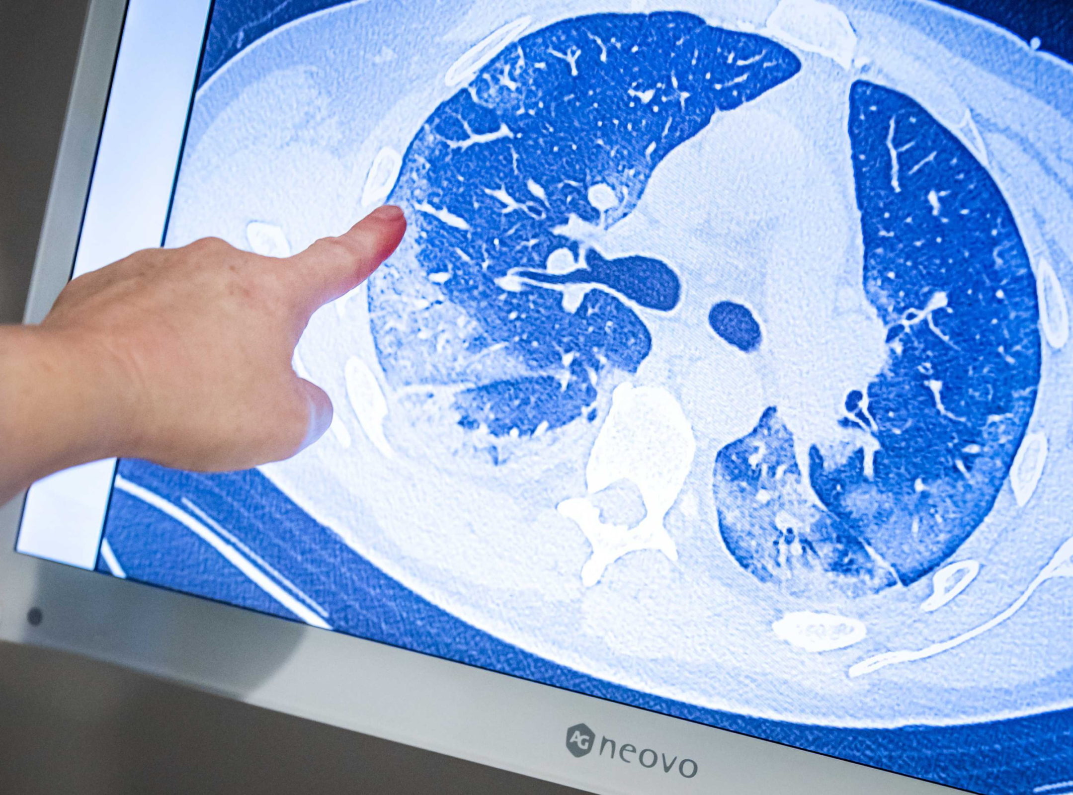 CT scan of the lungs of a coronavirus patient